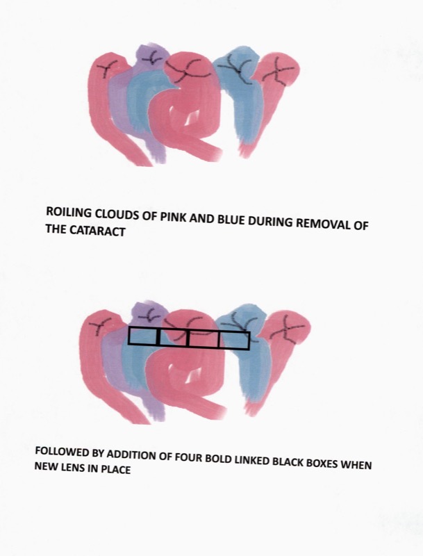 Patient drawing: roiling lavender-pink clouds seen during cataract surgery